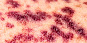 Approaching patient with thrombocytopenia