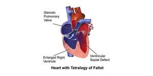 Teratology of fallot