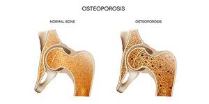 Osteoporosis