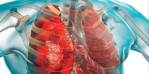 Management of TB Exposure