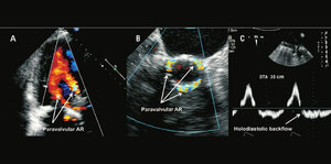 Echocardiography Assessment of Aortic Prosthetic valve