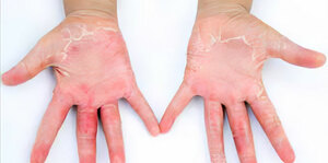 Approach to a patient with shock syndrome