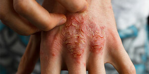 Common Dermatological Conditions