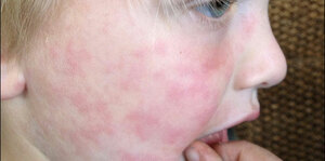 Approach to Child with Skin Rash