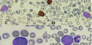 Morphology of Peripheral Blood