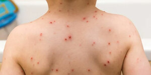 Common Rash in Children