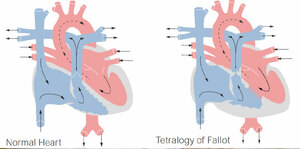 Management of Cyanotic Spells, Pathophysiology and Stepwise Approach